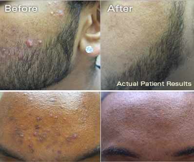 acne_results